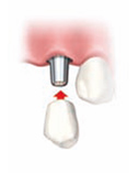インプラントの結合を確認後人口歯を入れます。