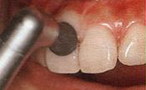 ラバーカップで歯と歯肉の間の汚れを除去